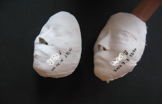페이스성형경락 석고본 전/후 비교  ( 20대 여성 /  뮤지컬배우 )