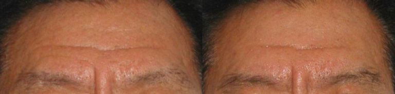  페이스성형경락 (이마주름) 전/ 후 비교  ( 50대 남성 / 회사원 )
