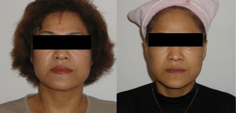 페이스성형경락관리 (표정주름, 얼굴 윤곽) 전/ 후 비교  ( 40대 여성 / 주부 )