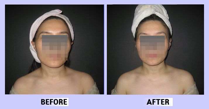 작은얼굴44 전후비교 앞면17