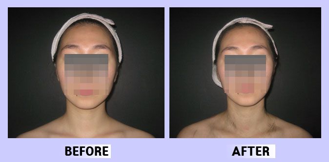 작은얼굴44 전후비교 앞면20
