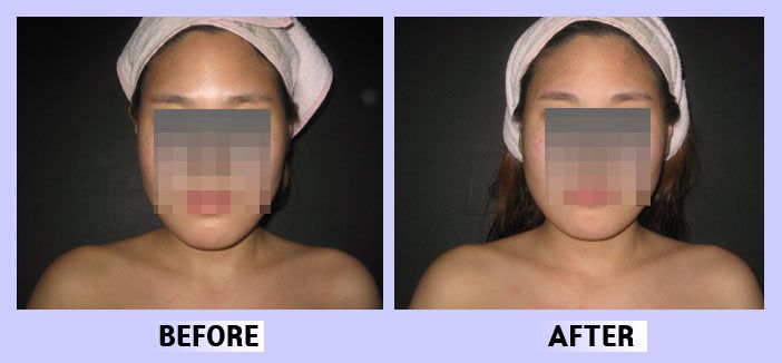 작은얼굴44 전후비교 앞면22