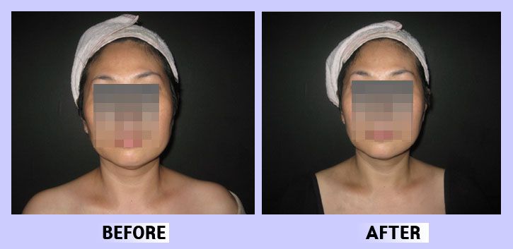 작은얼굴44 전후비교 앞면25