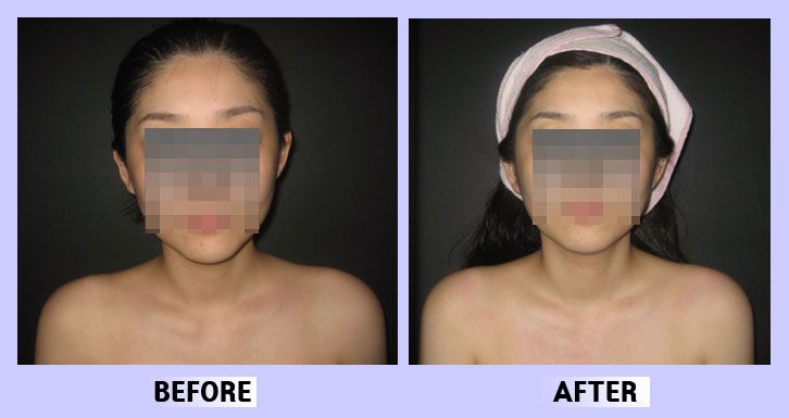작은얼굴44 전후비교 앞면33
