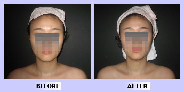 작은얼굴44 전후비교 앞면35