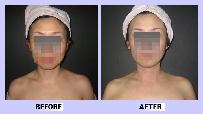 작은얼굴44 전후비교 앞면36