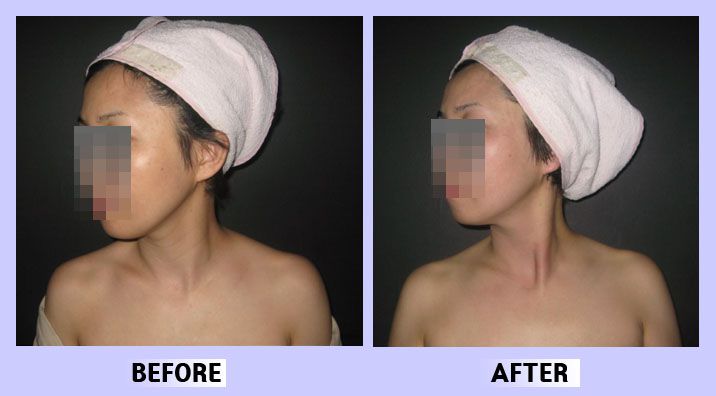 안면윤곽 사각턱 전후비교26