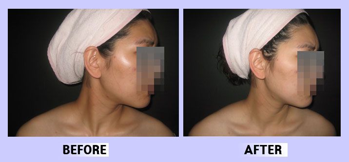 안면윤곽 사각턱 전후비교27