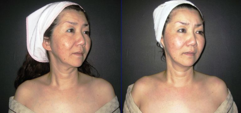 안면윤곽4D관리 비교 ( 40대 여성 / 관광객(일본) )