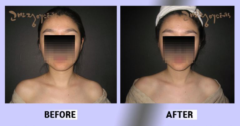 작은얼굴44 전후비교 앞면43