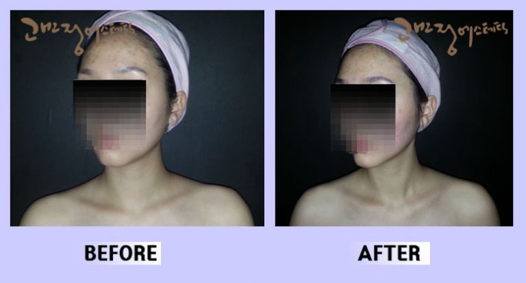안면윤곽 사각턱 전후비교31
