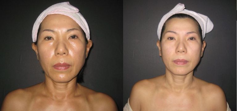 페이스성형경락관리 전/후 비교 ( 50대 여성 / 주부 )