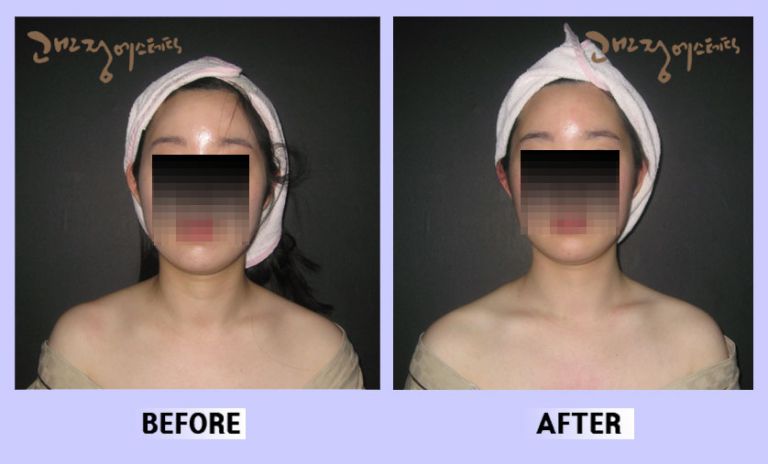 작은얼굴44 전후비교 앞면50