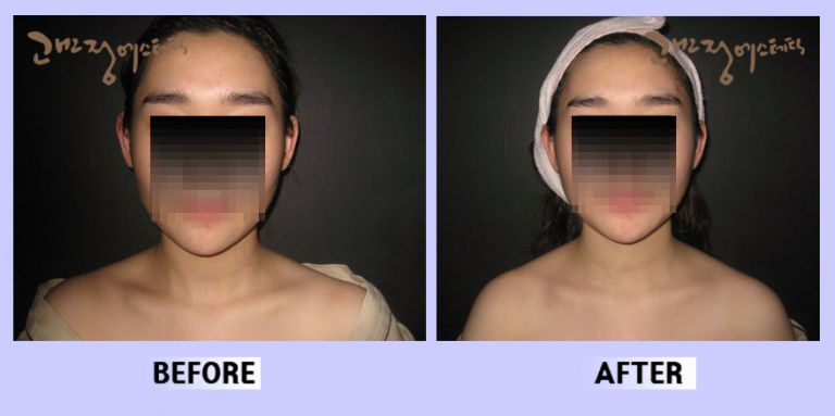 작은얼굴44 전후비교 앞면52