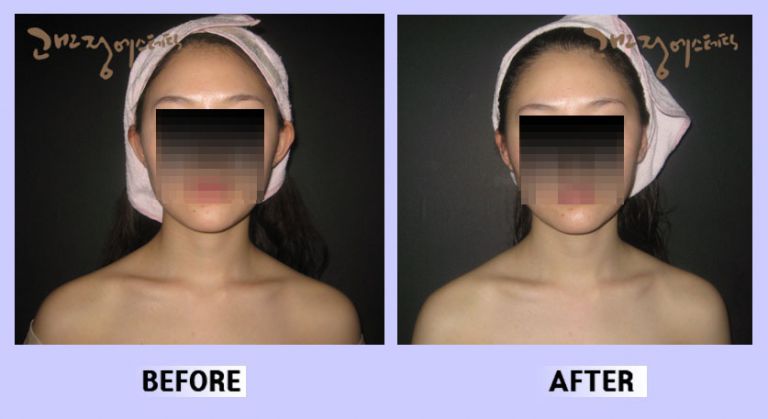 작은얼굴44 전후비교 앞면55