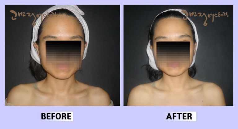 작은얼굴44 전후비교 앞면57