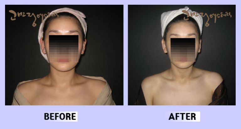 작은얼굴44 전후비교 앞면62