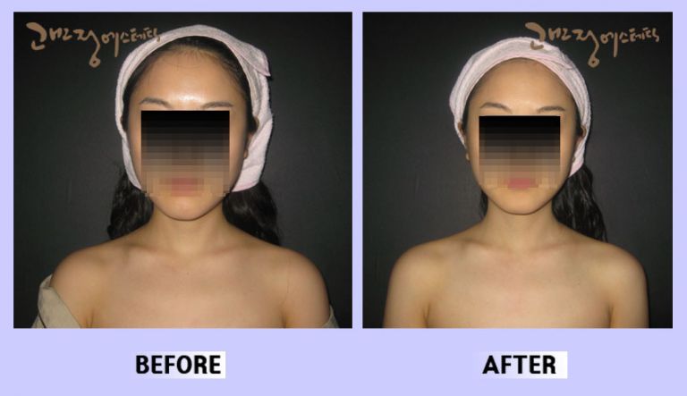 작은얼굴44 전후비교 앞면67