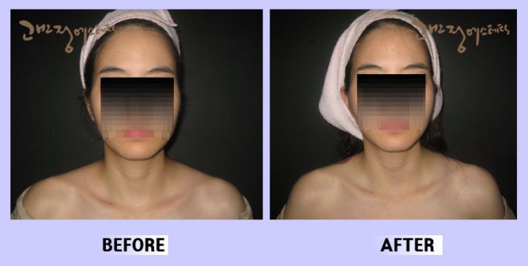작은얼굴44 전후비교 앞면70