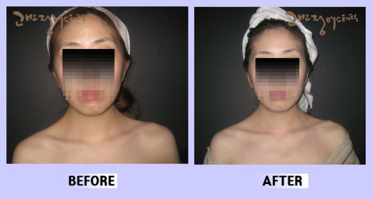 작은얼굴44 전후비교 앞면80