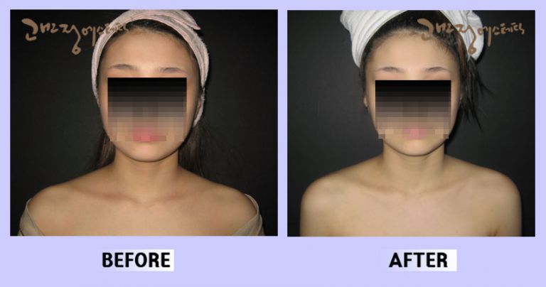 작은얼굴44 전후비교 앞면83